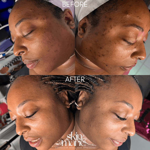 Microneedling Package of 4