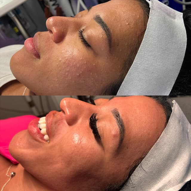 Biweekly Acne Bootcamp at skinbymarie in Las Vegas, NV